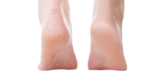 Herbal Skin Doctor Heel Balm – For Rough, Dry & Cracked Feet (50g)